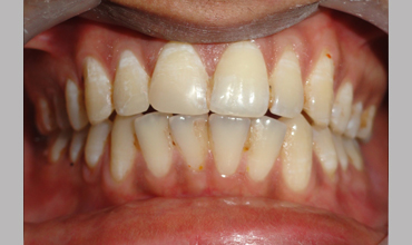 Dentures treatment in Anand
                        